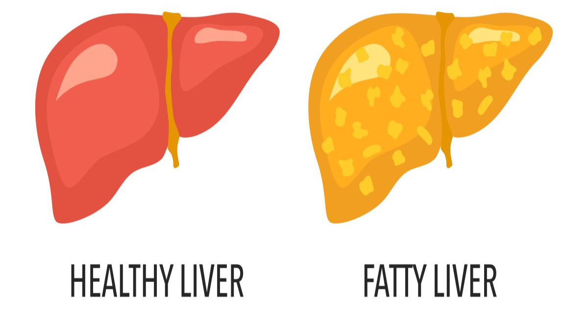 Fatty Liver NASH Symptoms and Treatment